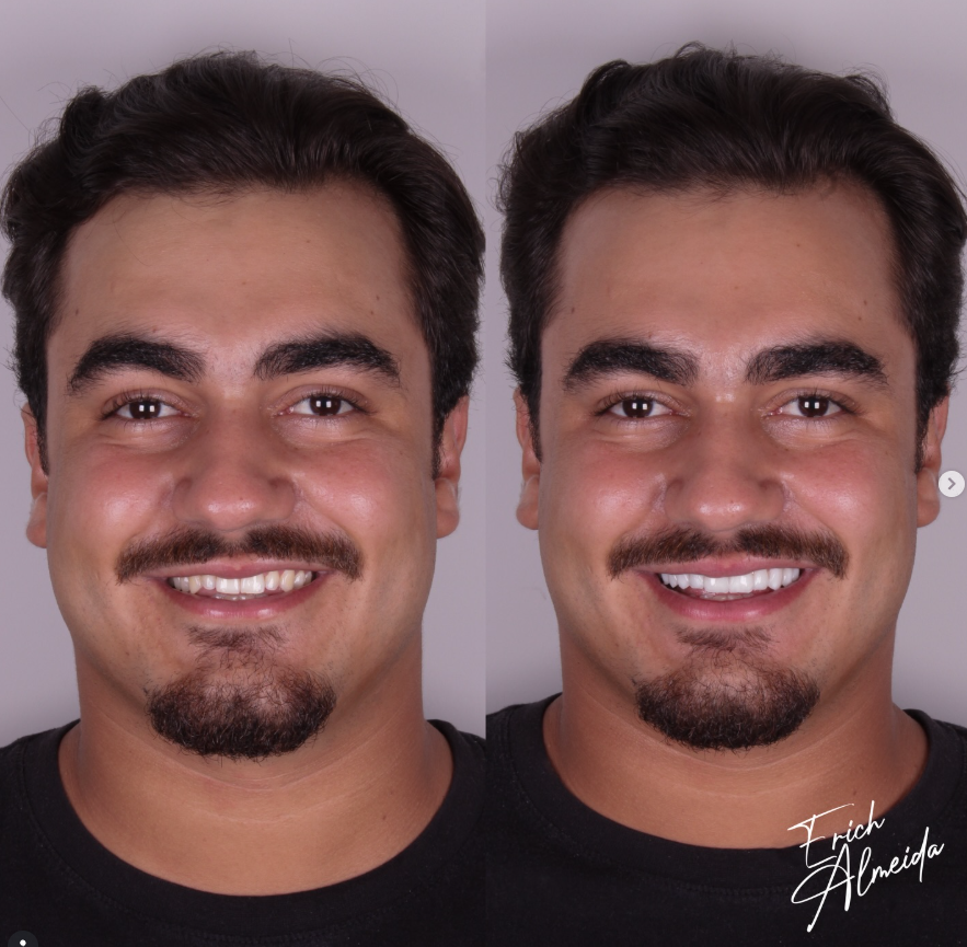 Antes